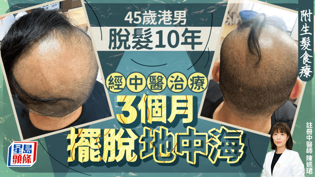 45歲港男脫髮10年 中醫治療3個月擺脫地中海 附生髮食療