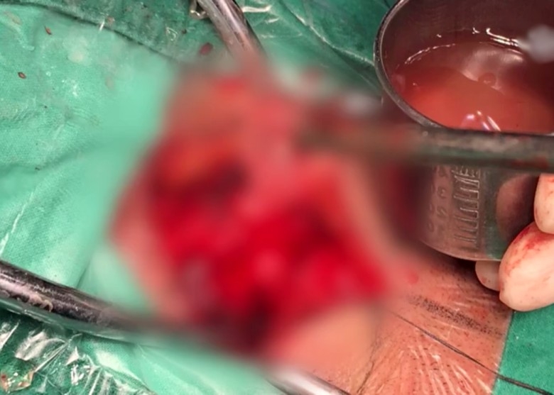 醫生進行開顱手術。（網圖）