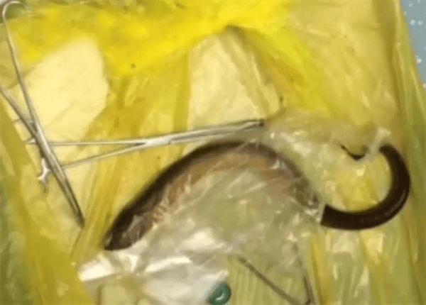 一條鰻魚通過手術從一名男子的腹部取出。FB圖