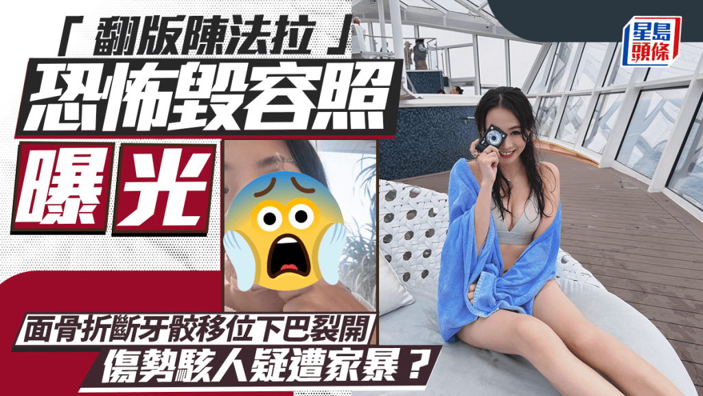 35歲「翻版陳法拉」恐怖毀容照曝光  面骨折斷牙骹移位下巴裂開  傷勢駭人疑遭家暴？