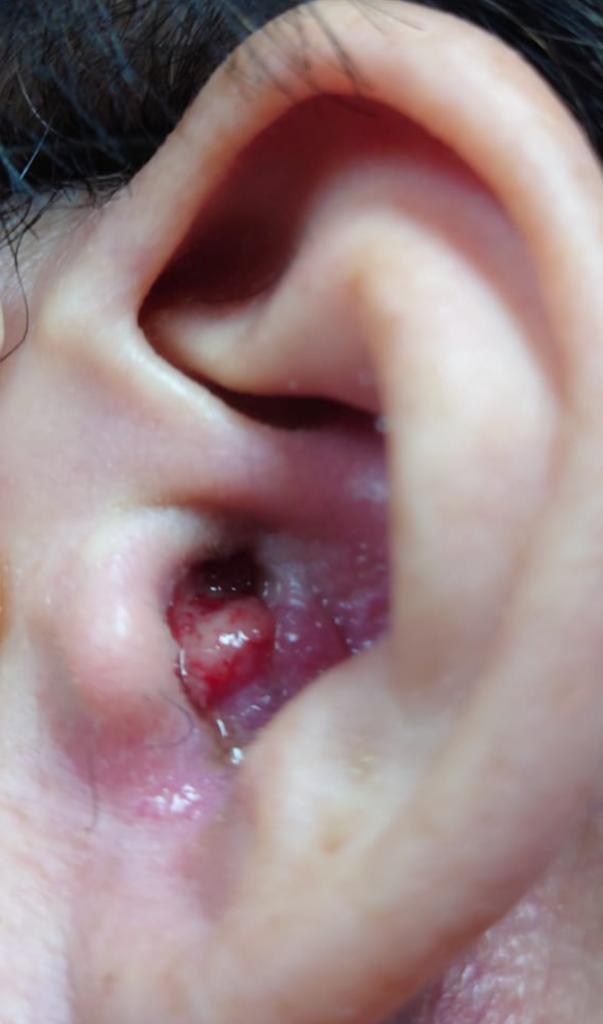 鄭先生早前左耳生了一個細小粉瘤，其後證實感染綠膿桿菌。