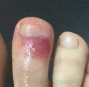 一些新冠肺炎患者的腳上出現了「類似水痘或麻疹」的病變。(網圖)