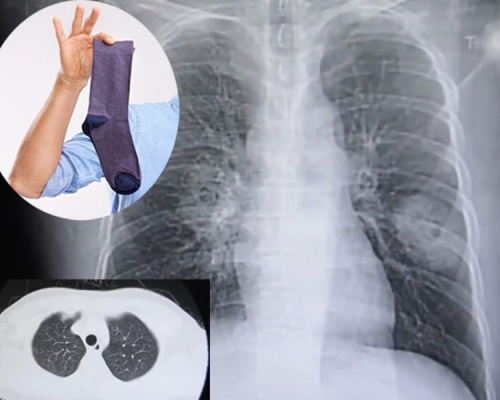 福建漳州一名男子肺部受真菌感染愈趨嚴重，他自爆有聞臭襪的癖好。（網圖）