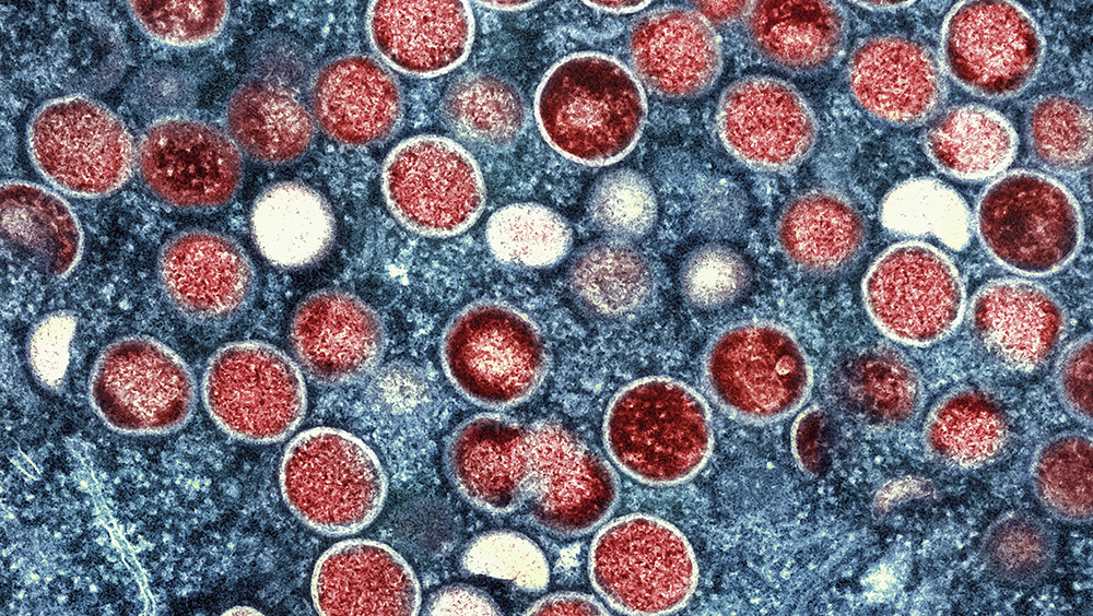 北京首次發現猴痘病例。AP資料圖
