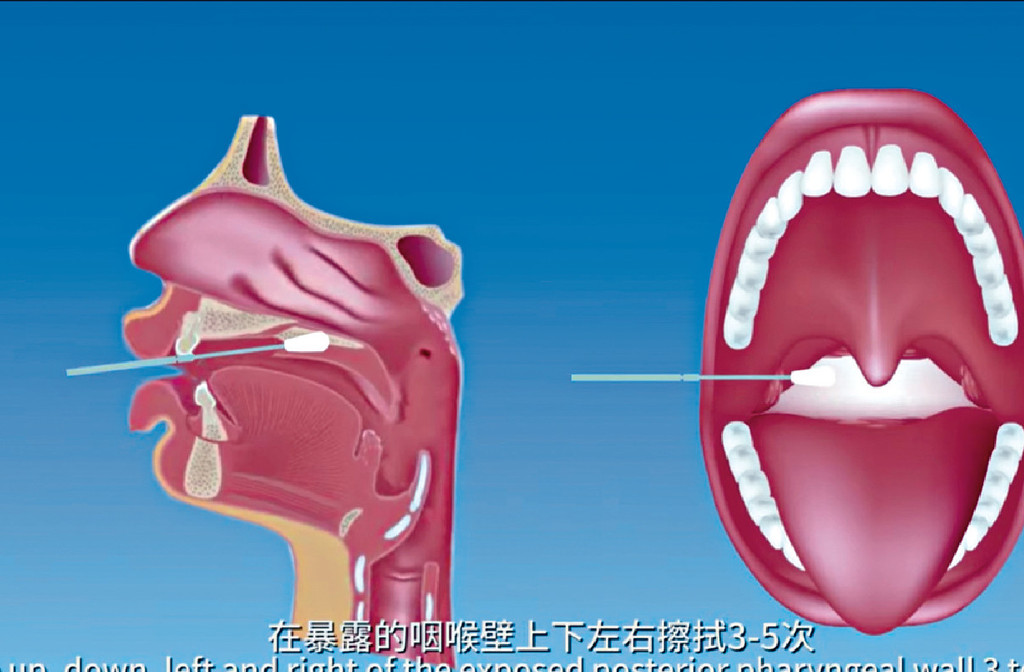 ■咽喉拭子採樣，將拭子放到喉嚨椗附。
