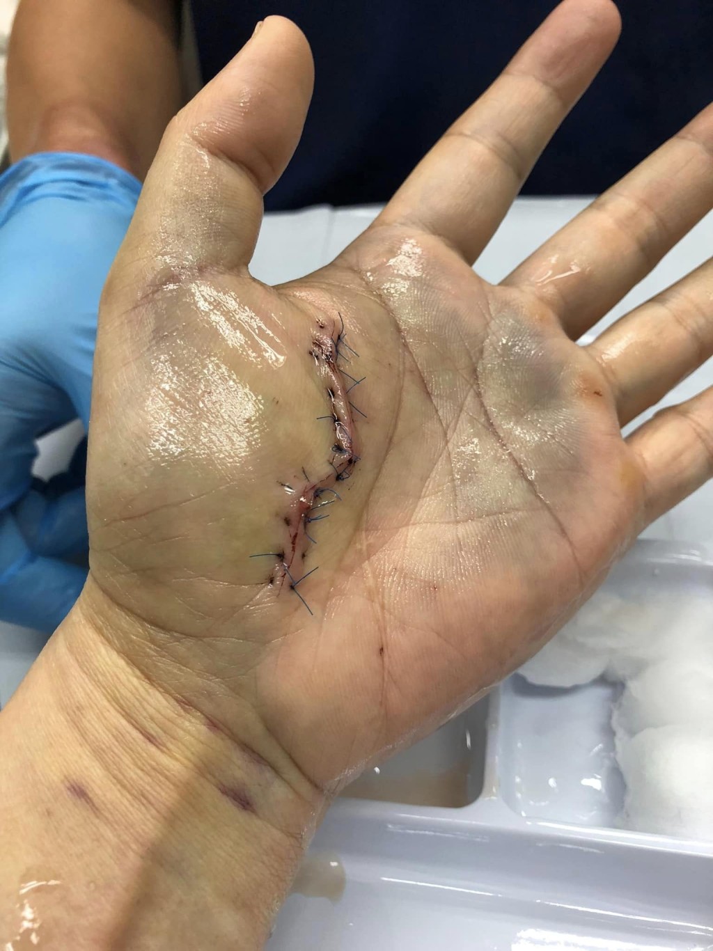 港男的手掌在事發後亦留下一道長傷口。「香港街市魚類海鮮研究社」FB