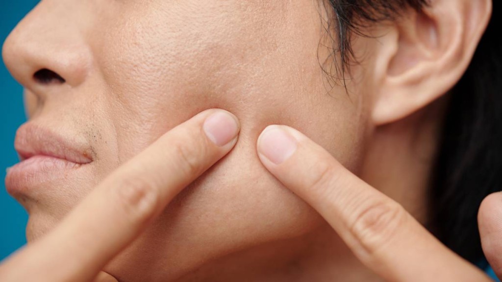 浙江有男大生未洗手便擠長在「危險三角區」的痘痘，導致患上血源性肺膿腫。示意圖。iStock