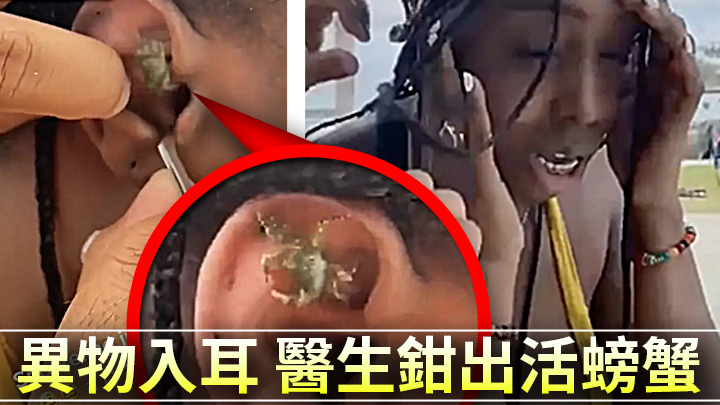 一名女遊客在浮潛時,突感有異物跑進耳朵內,最後竟鉗出一隻活生生的小螃蟹。(影片截圖)