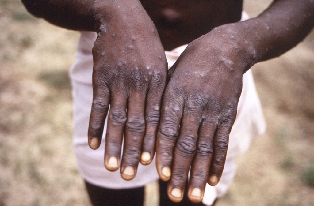 猴痘是一种由猴痘病毒感染所致的人兽共患病毒性疾病。AP资料图