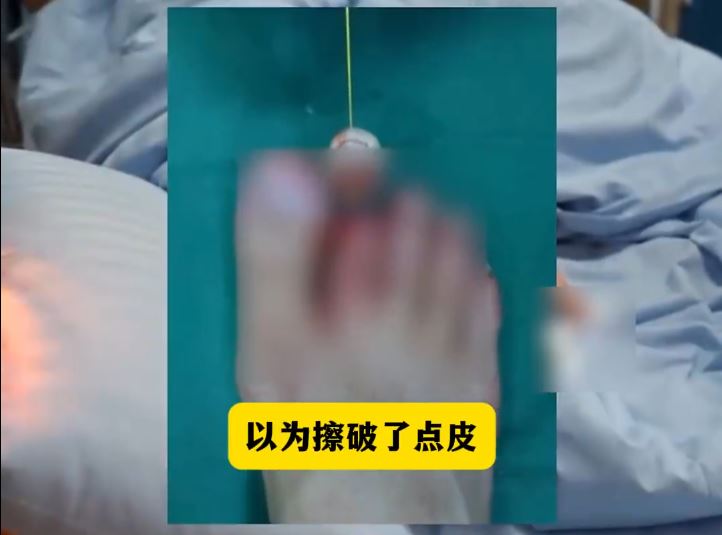 广东16岁少年着人字拖行路玩手机，踢中石头致一截脚趾飞脱。广州日报