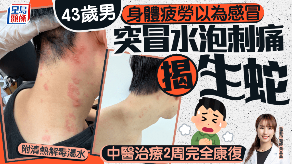 43歲男身體疲勞以為感冒 突冒水泡刺痛揭生蛇 中醫治療2周完全康復｜附清熱解毒湯水