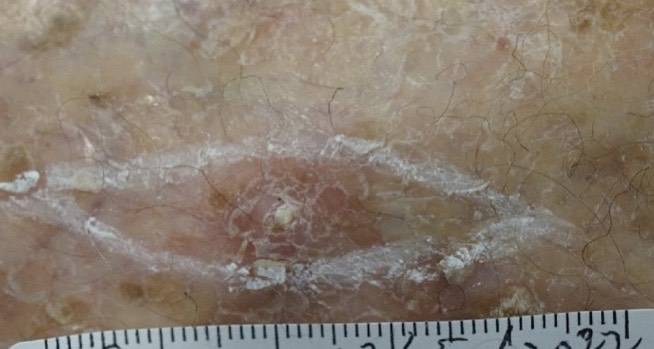 鱗狀細胞皮膚癌（圖片由受訪者提供）