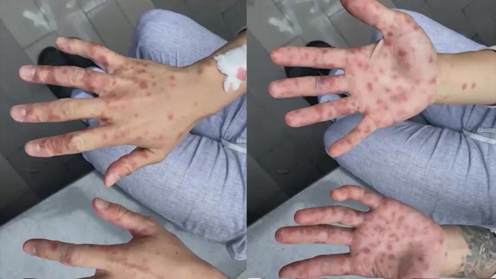 猴痘病患者。網上圖片