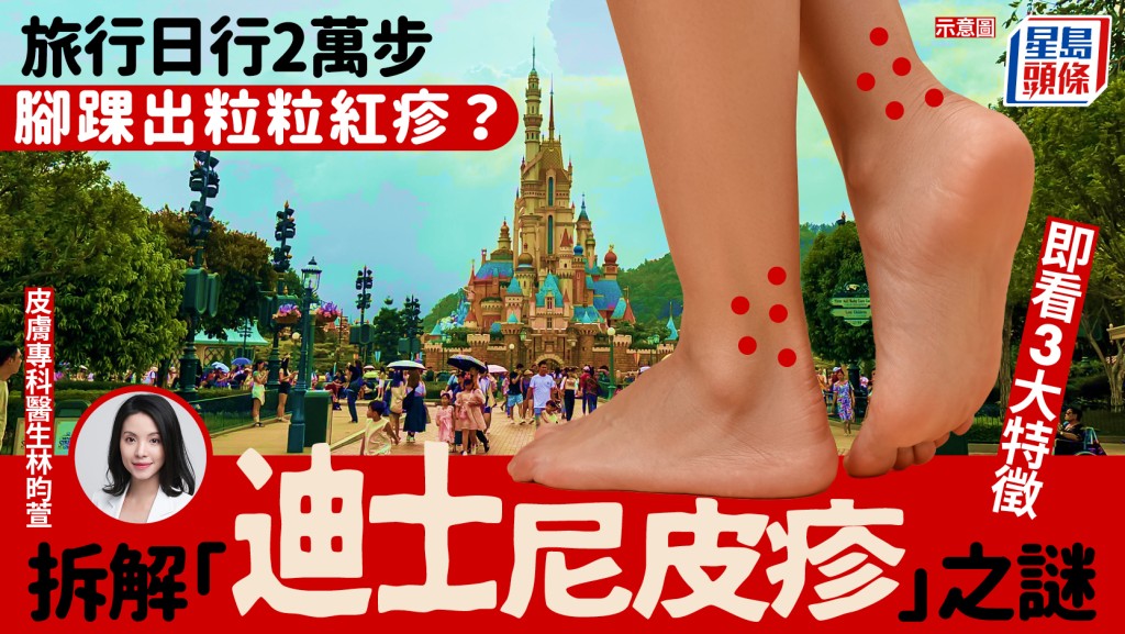 旅行日行2萬步、腳踝出紅疹？拆解「迪士尼皮疹」之謎 即看3大特徵