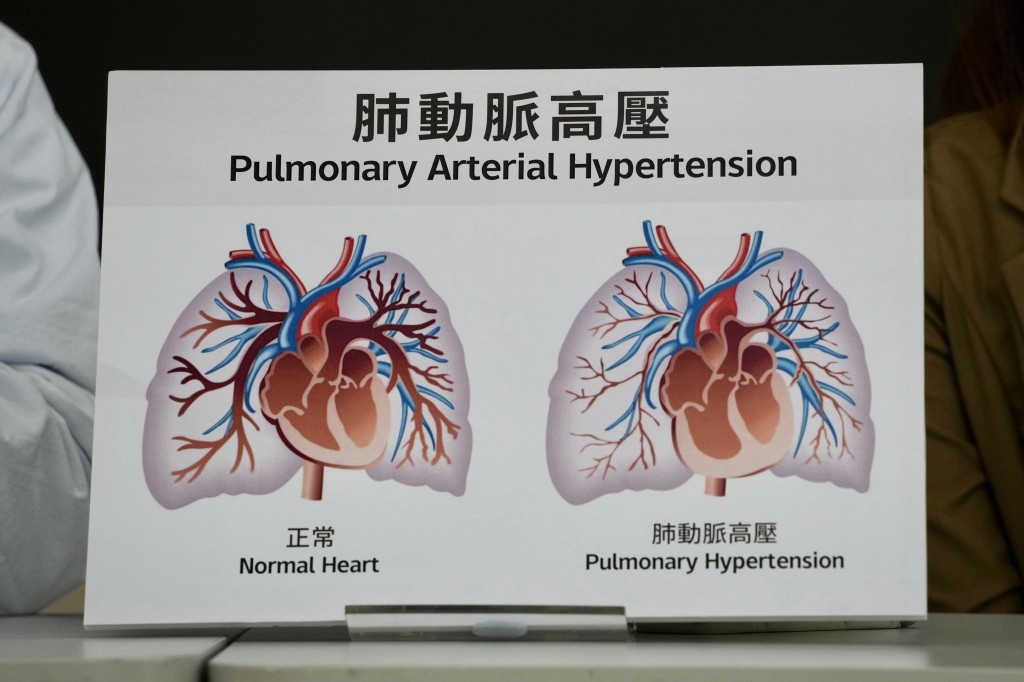吴淑贤3年前开始出现肺动脉高压，至去年3月病情恶化。