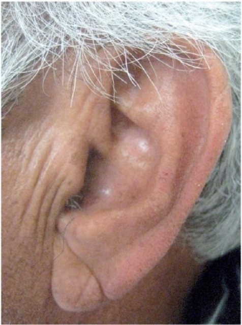 是Sanders T. Frank 博士在20名心絞痛患者身上觀察到的這種皺紋而命名（史丹佛醫學院圖片）