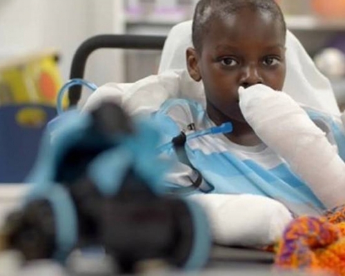 美國10歲男童因新冠肺炎引發「兒童多系統炎症綜合症」，被迫接受4次截肢手術，失去雙掌與雙腿。（網圖）