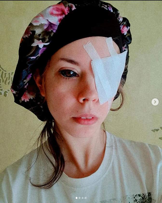 波蘭女子想將眼白刺成黑色，然而因刺青師的疏失，導致她左眼近乎失明、右眼須裝義眼。IG圖