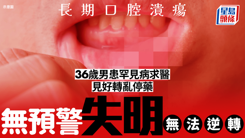 痱滋當熱氣︱36歲男長期口腔潰瘍  見好轉亂停治療致無預警失明