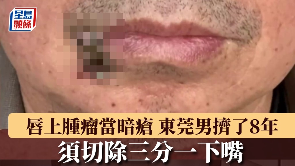 唇上肿物当暗疮，东莞男狂挤8年变巨瘤。 