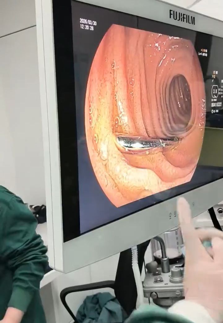 男孩誤吞圓規針，要由醫護團體透過手術取出。《現代快報》