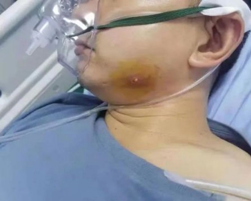 湖南26歲男擠暗瘡後 呼吸衰竭患敗血症及尿毒症。
