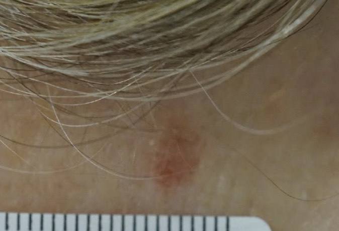 基底細胞皮膚癌（圖片由受訪者提供）