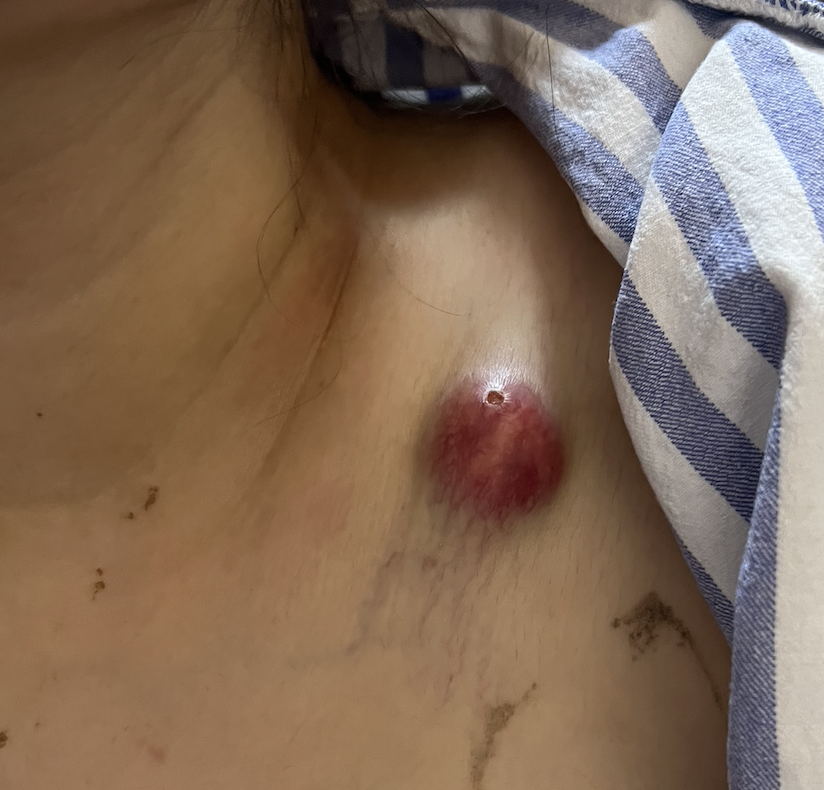 主診醫生發現小欣胸壁有明顯腫塊，表面發紅，質地十分硬。