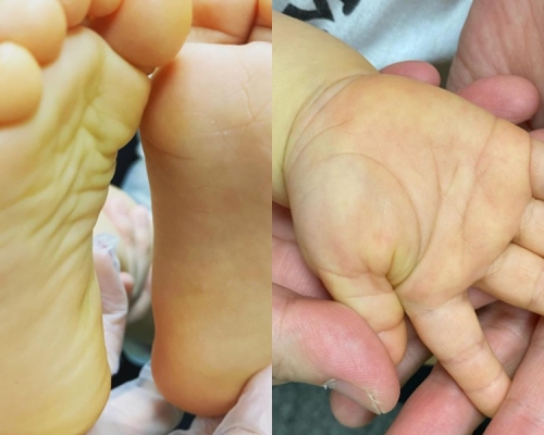 小朋友皮膚發黃皮膚。網圖