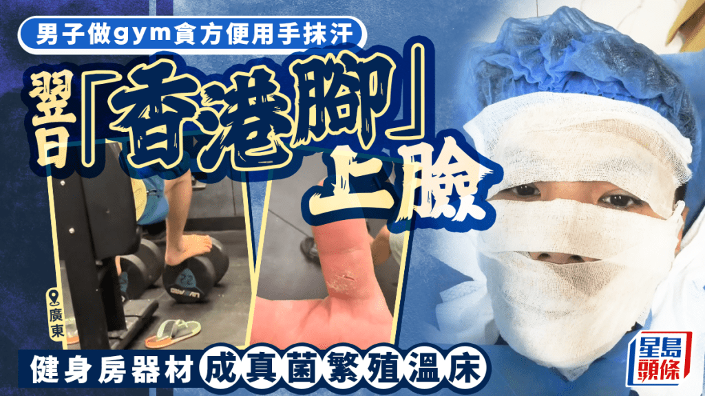 广东男「举完铁」用手擦汗致脸部真菌感染，事件曝光后，大批网民留言分享共鸣。