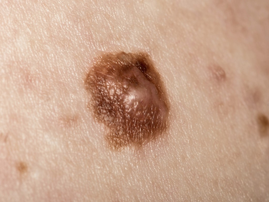 皮膚癌特徵（iStock圖片）