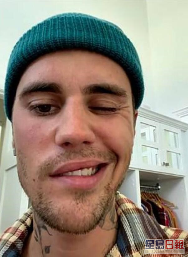 Justin Bieber上月公佈患有「拉姆齊亨特綜合症」，導致右邊面部癱瘓。