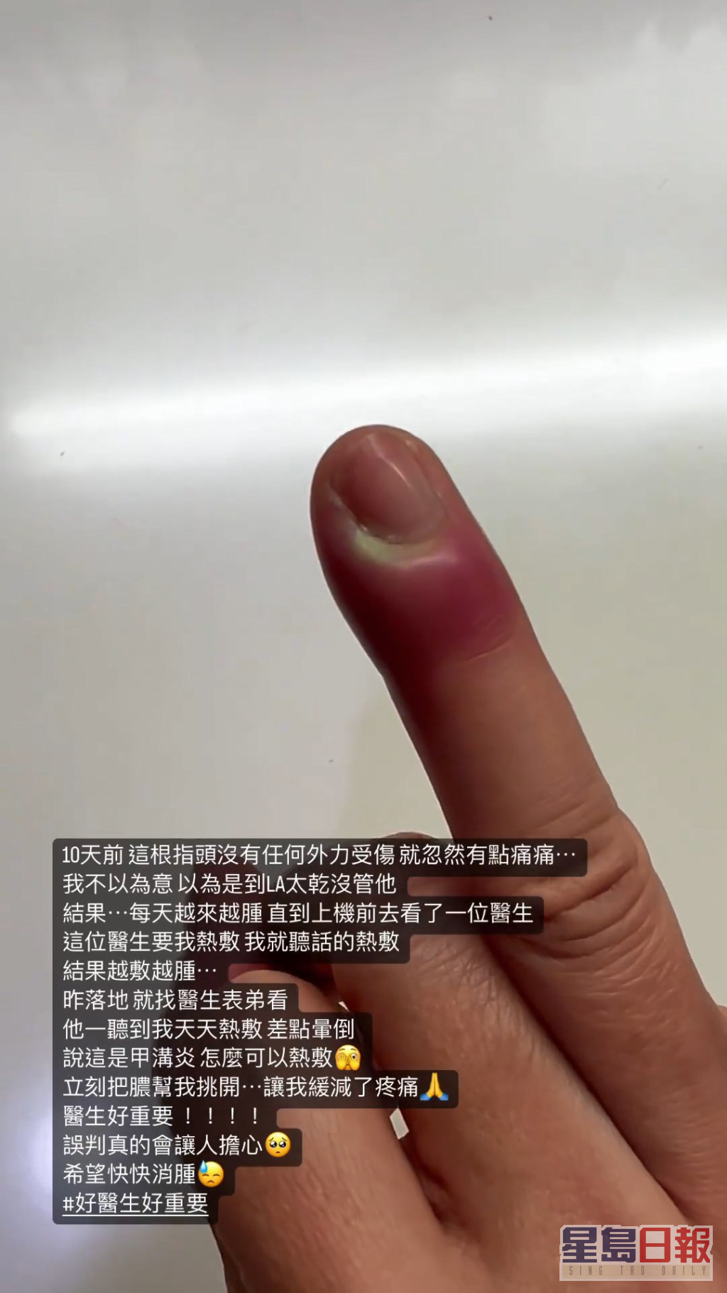 賈靜雯的手指已含膿。