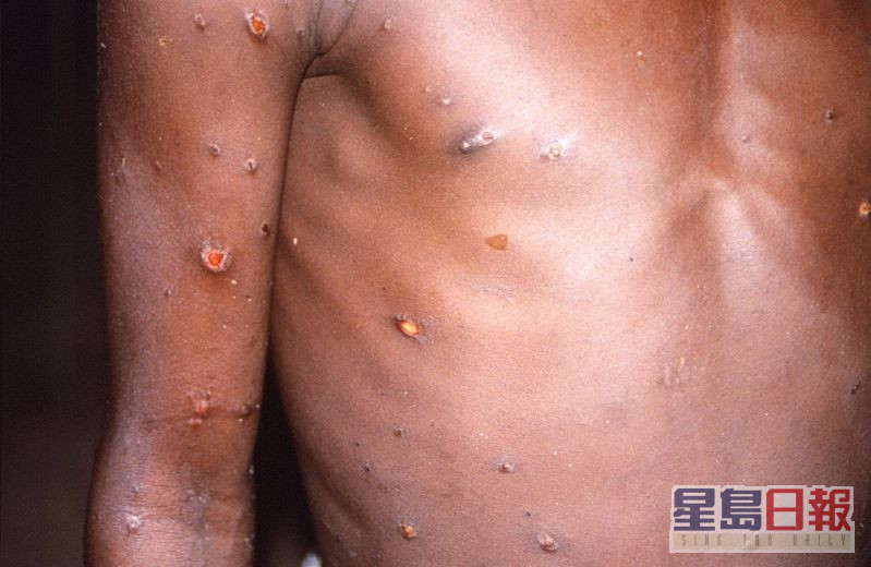 世卫收逾300宗猴痘确诊或疑似病例报告。网图