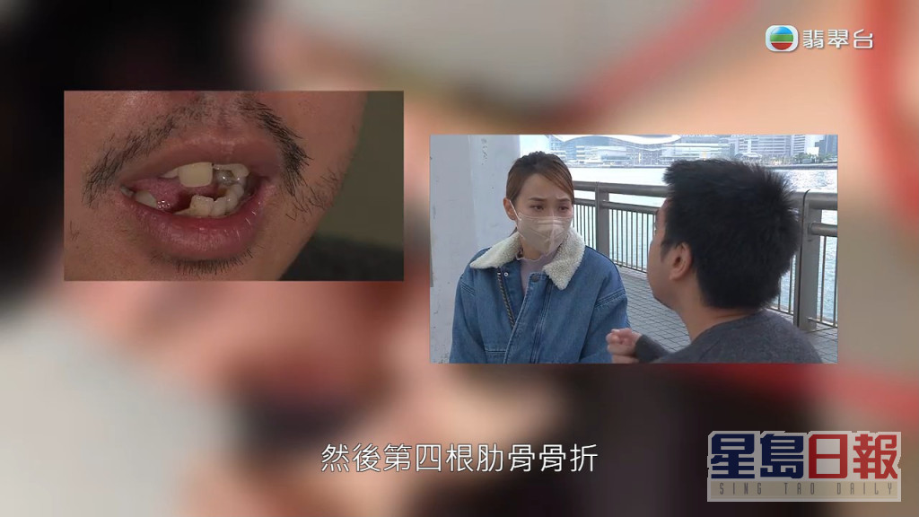 陈先生被打崩牙，又被打断肋骨，最后昏迷3日，在加护病房留医近一个月。