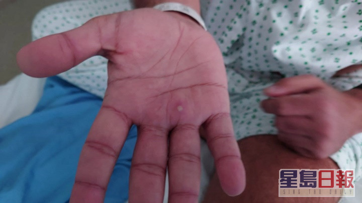 世衞至今录得各国呈报约1.4万宗猴痘个案。路透社资料图片