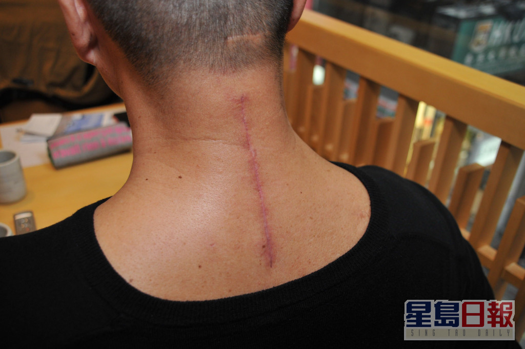 11年前邓达智曾接受颈椎手术，留下7寸伤疤。