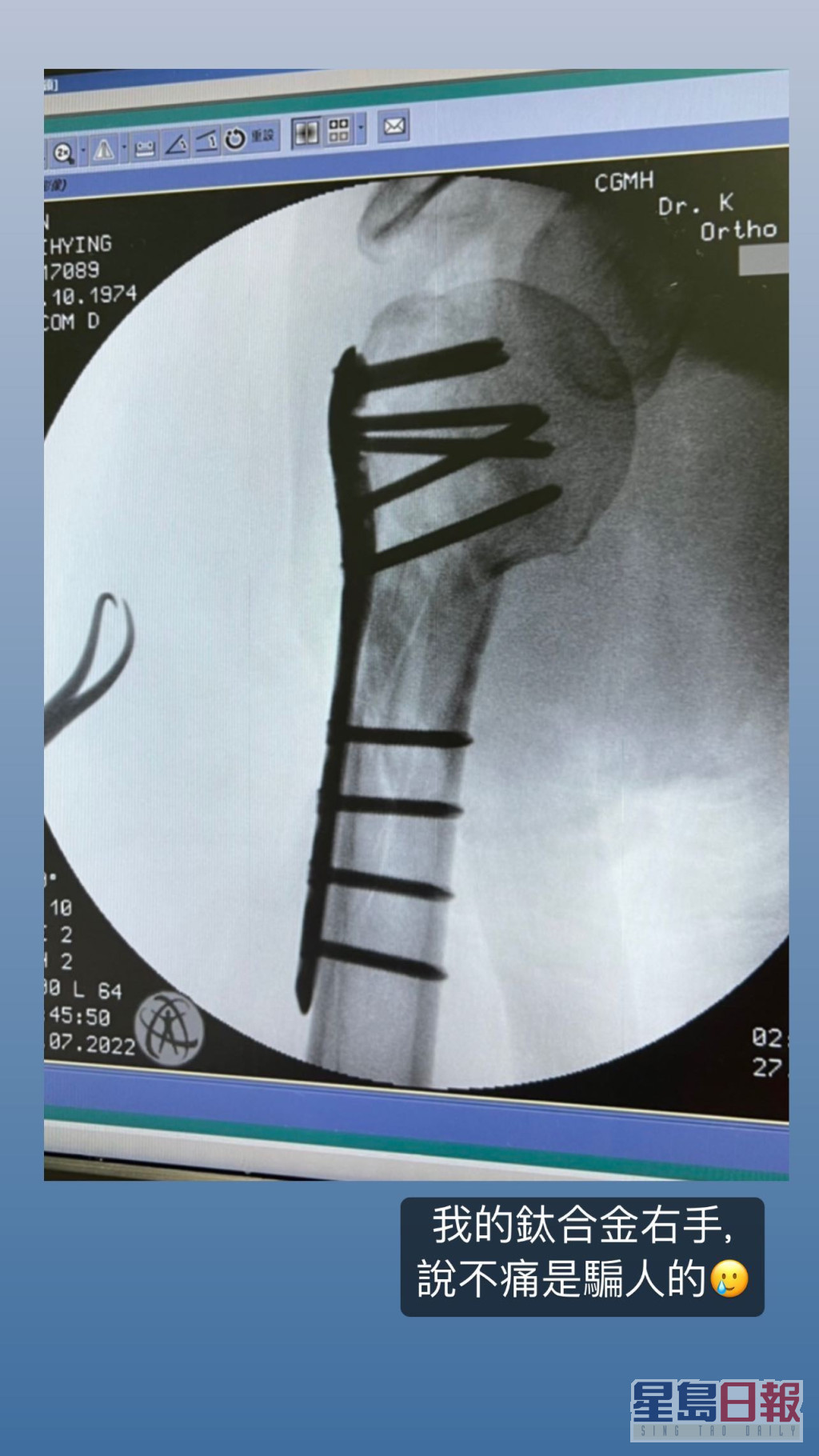 林志穎公開右臂的X光相，見到一排鋼釘及鋼板。