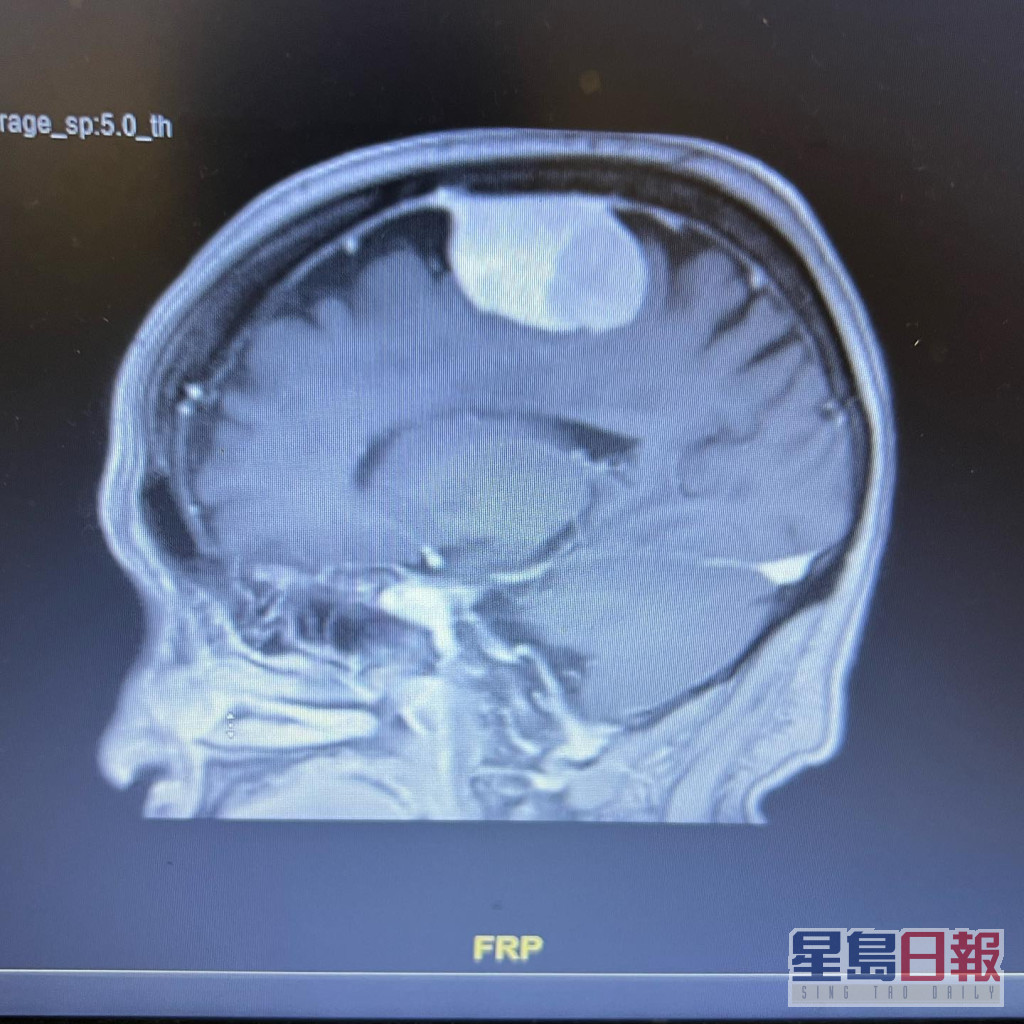劉母的腦掃描。