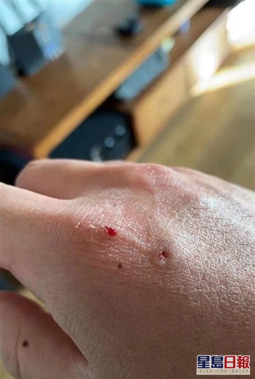 沈先生的手被咬伤。互联网图片