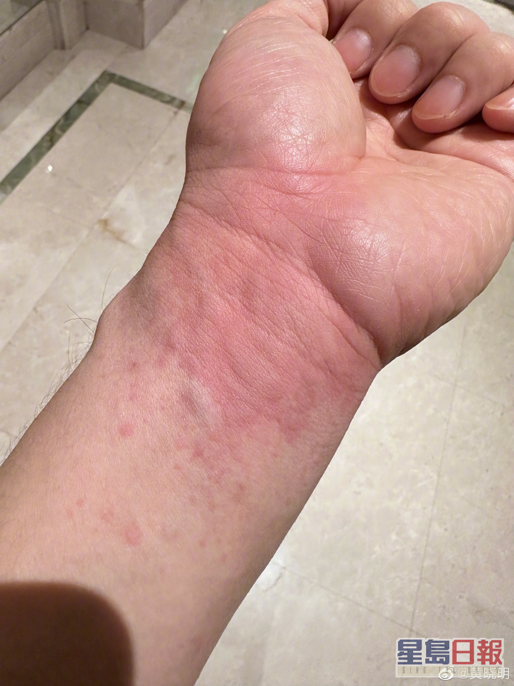 黃曉明最近返青島歎不少家鄉菜後，手臂卻出現急性蕁麻疹。