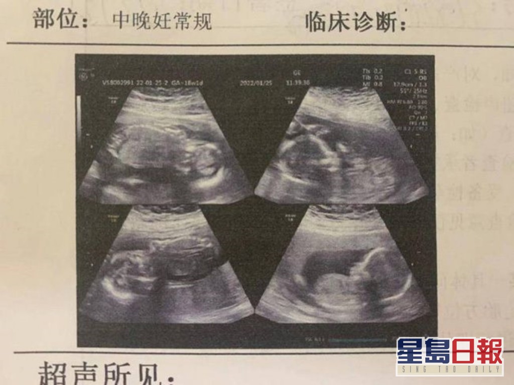 兩男嬰早產兩個留母親腹中保胎。網圖