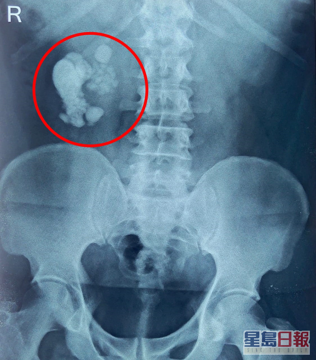 从X光片可见，病人有大量肾石（红圈）。互联网图片