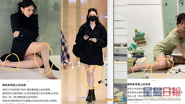 網民翻睇韓韶禧近年的照片，指她身上有不少疑似瘀傷。