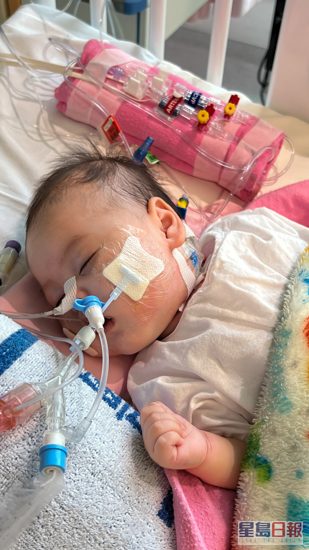 4个月大女婴芷希于今日凌晨完成心脏移植手术。资料图片