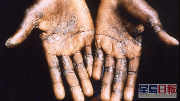 猴痘主要经体夜接触传播，病徵包括发烧及出疹等。路透社资料图片