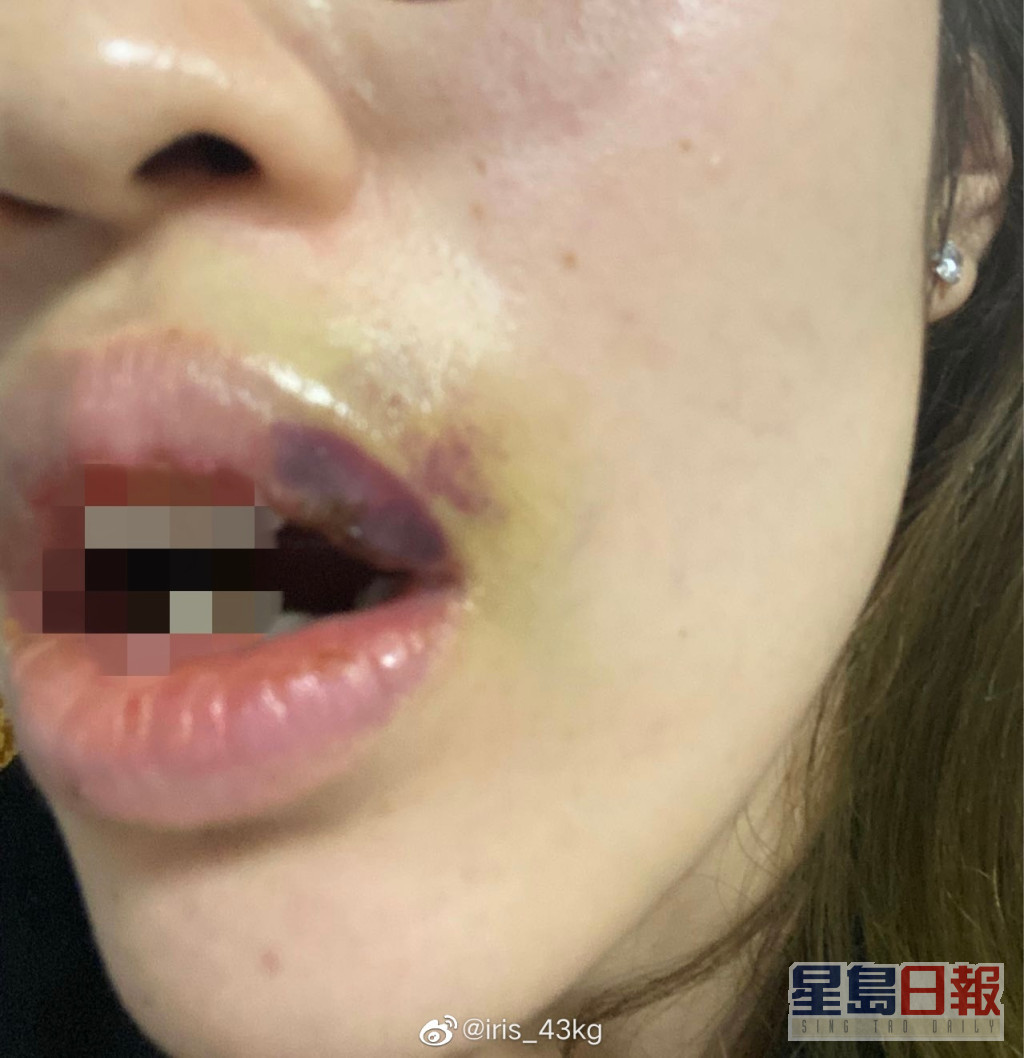 「iris_43kg」同时贴出受伤照片，她在文中指两度遭对方掌掴，更遭受对方言语暴力。
