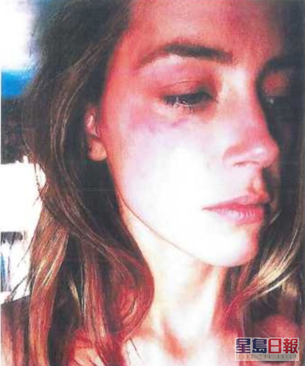 安柏同样呈上据指被尊尼家暴后的受伤图片。