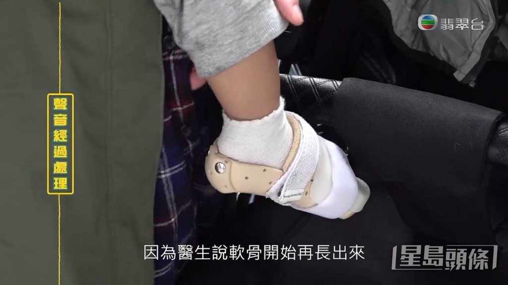 至於骨折方面，醫生表示現在軟骨開始重新生長，需要再作觀察，如果發現變歪，或有需要植入一根類似鋼根的物體以固定位置。