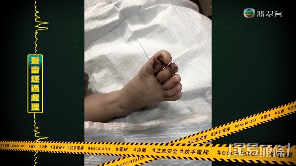 當時囝囝腳趾已經滲滿血水，陳太更發現他的腳趾公指甲疑似已經剝落。